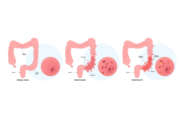 διάτρηση εντέρου