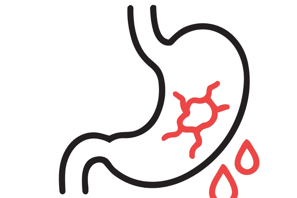 γαστρορραγία